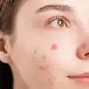 از بین بردن جوش صورت در یک روز
