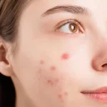 از بین بردن جوش صورت در یک روز