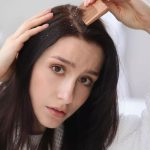 درمان شوره سر